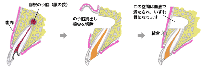 歯根端切除術概念図